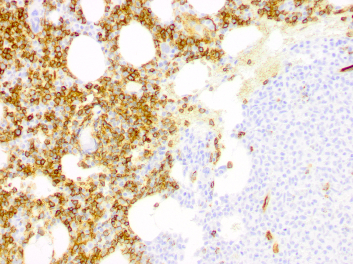 Immunohistochemical staining for CD34 highlights sheets of blasts (left half of the image). The plasmacytoid dendritic cells do not express CD34 (right half of the image)..